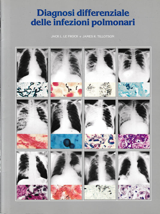 Diagnosi differenziale delle infezioni polmonari - copertina
